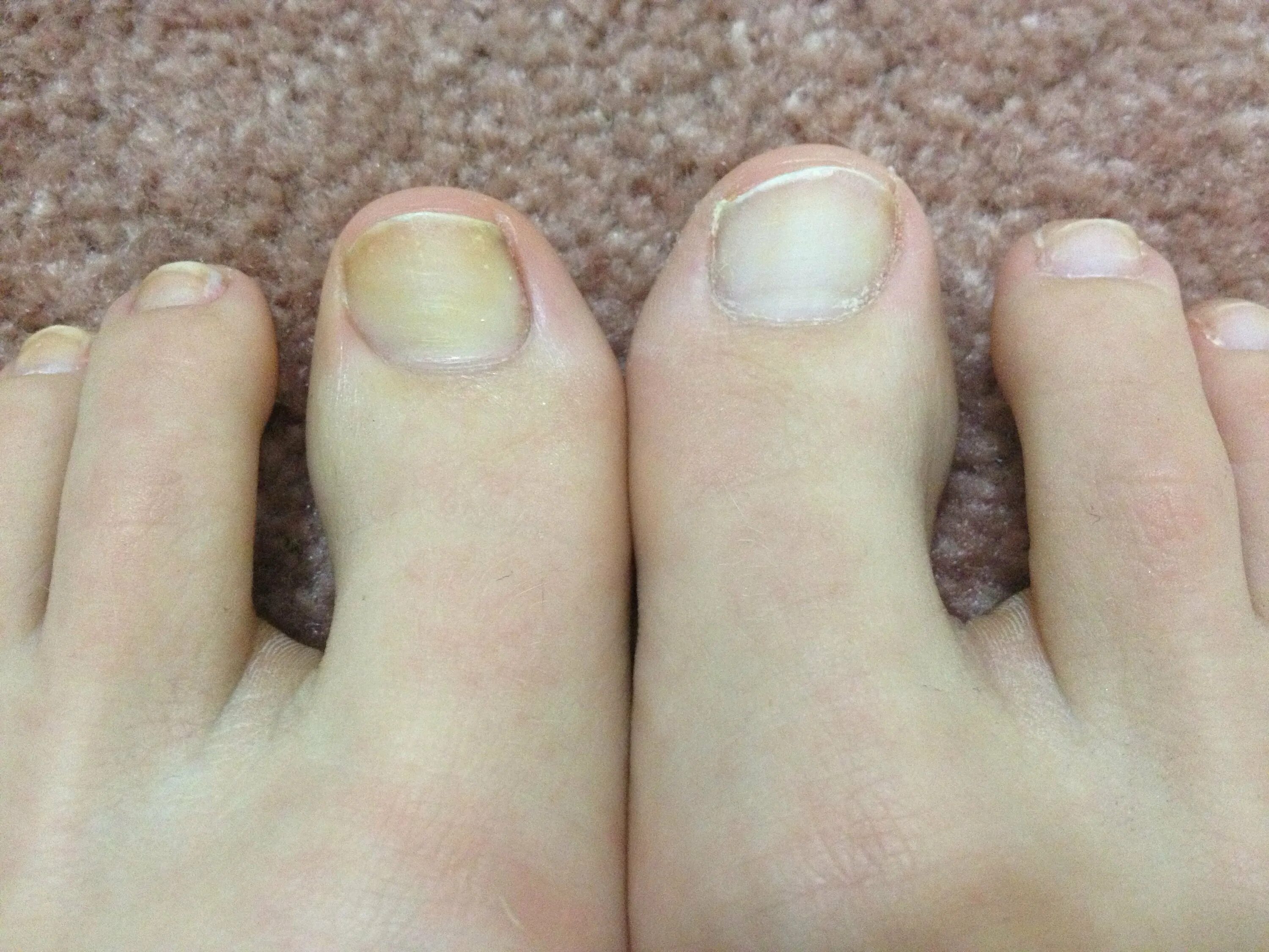 Почему пальцы пожелтели. Гиперкератотический онихолизис. Ногти на ногах.