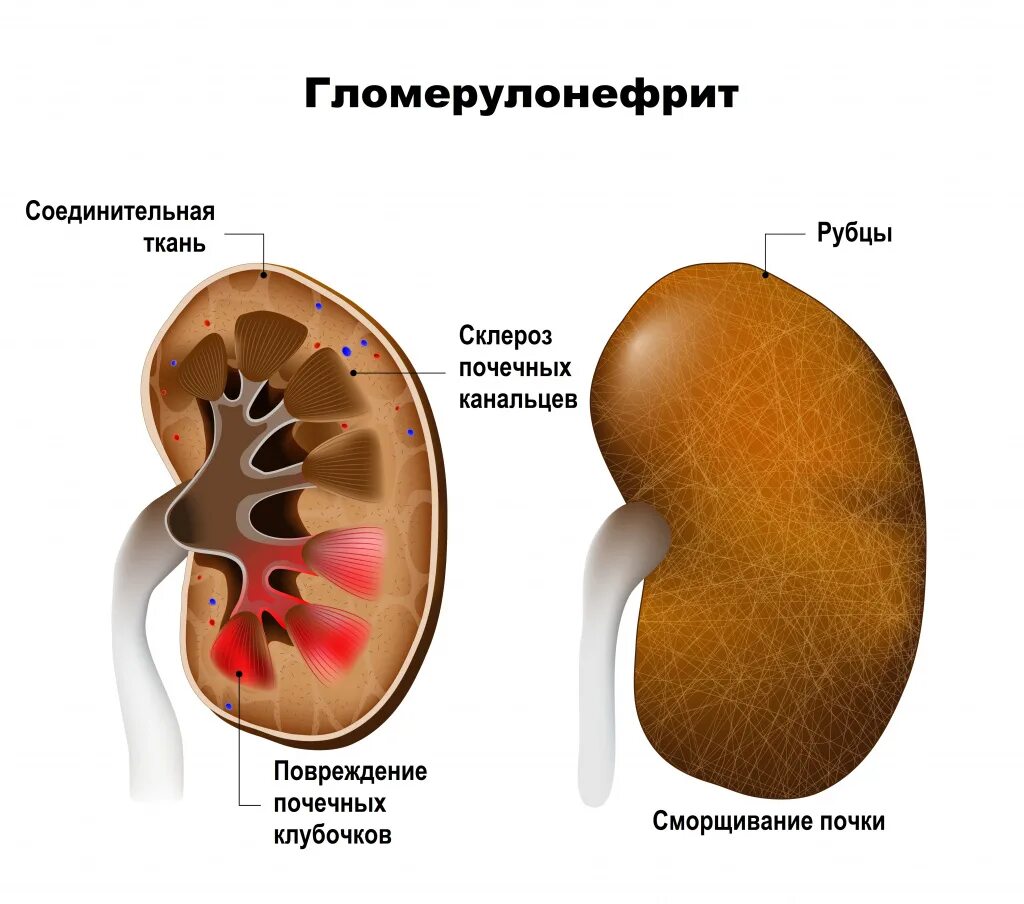 Хронический гломерулонефрит (хгн). Почка пораженная гломерулонефритом. Острый нефрит и гломерулонефрит. Гломерулонефрит здоровая и больная почка. Поражение клубочков почек