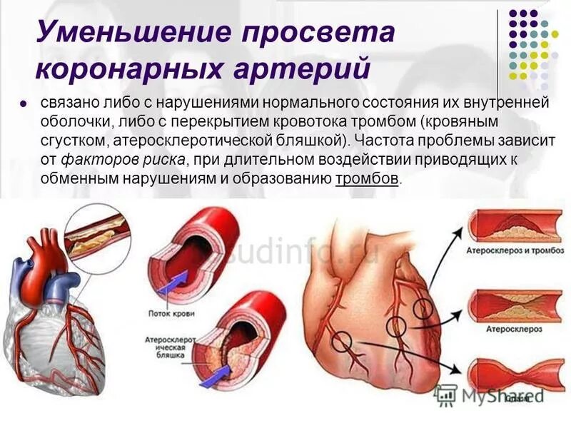 Коронарные осложнения