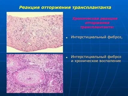 Иммунное отторжение