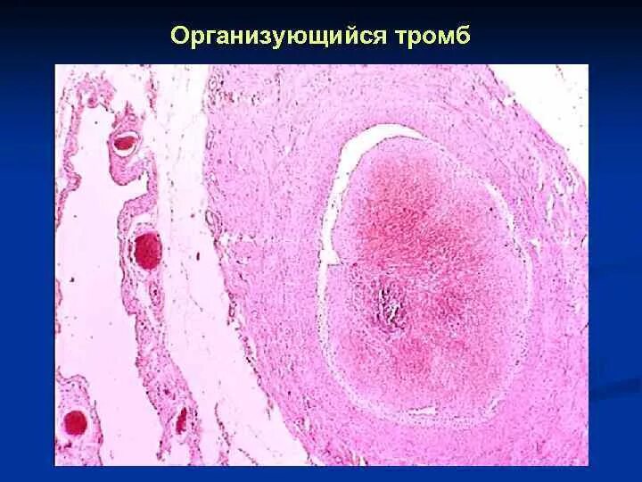 Смешанный тромб. Организованный тромб в Вене микропрепарат. Красный обтурирующий тромб микропрепарат. Септический тромбофлебит микропрепарат. Организованный тромб микропрепарат.