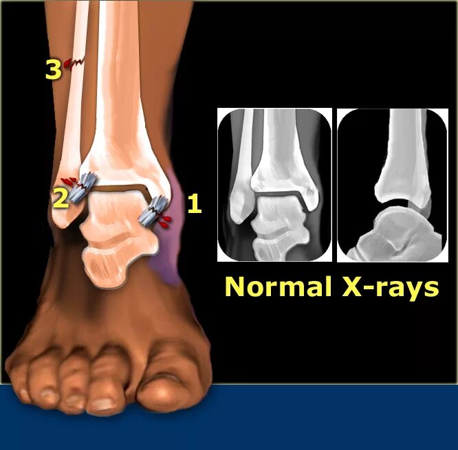 Дистальный разрыв. Перелом лодыжки синдесмоз. Межберцовый синдесмоз голеностопного сустава. Разрыв межберцового синдесмоза голеностопного сустава. Разрыв межберцового синдесмоза голеностопного сустава рентген.