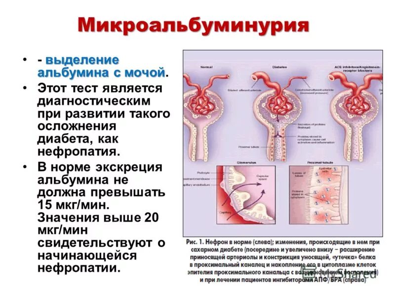 Повышенный альбумин в моче. Экскреция альбумина с мочой. Микроальбуминурия. Высокая экскреция альбумина. Повышение альбумина в моче.