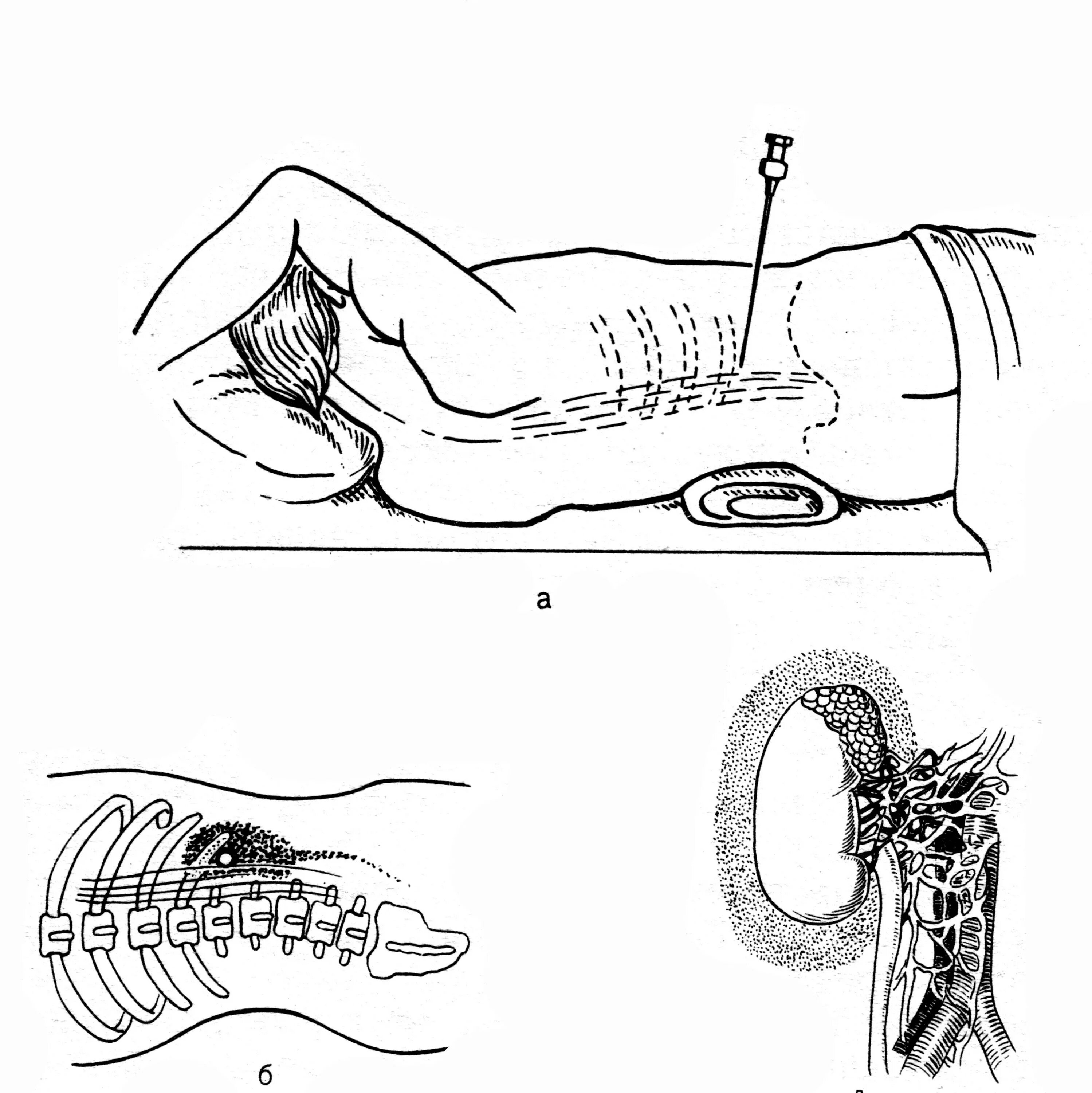 Обезболивающая блокада. Паранефральная блокада по Вишневскому. Поясничная паранефральная блокада. Паранефральная блокада техника. Паранефральная новокаиновая блокада.