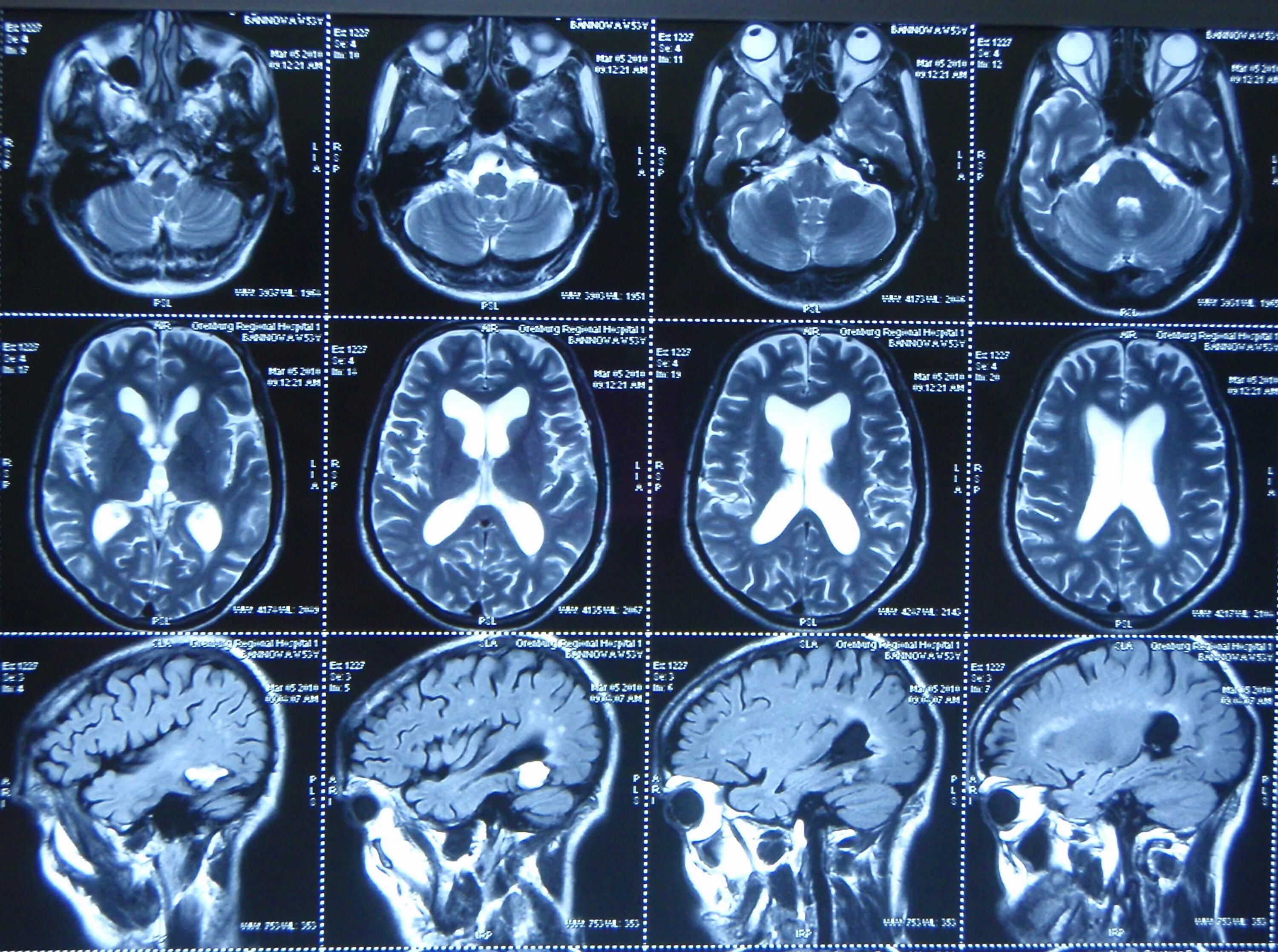 Мрт магнитно-резонансная томография головного мозга. Компьютерная томография кт головного мозга. Кт томограмма головного мозга. Мрт мозга сбоку.