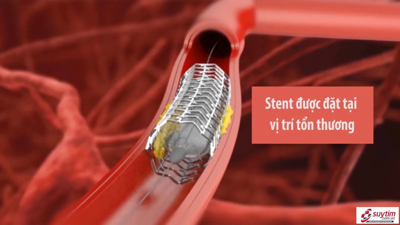 Коронарография пункция артерии. Эндоваскулярная окклюзия варикоцеле. Стентирование по омс. Стентирование по омс. Стентирование сосудов эндоваскулярное.
