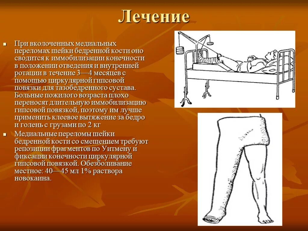 Оперативное лечение перелома костей. Гипсовая иммобилизация тазобедренного сустава. Лечебная иммобилизация бедренной кости. Аддукционный перелом шейки бедра. Транспортировка пациента при переломе шейки бедра.