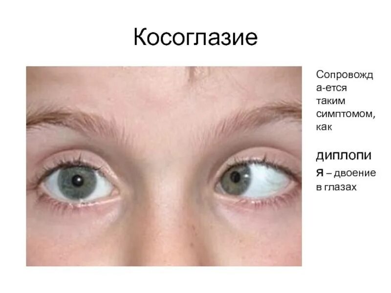 В глазах двоится и расплывается почему