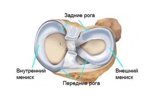 Структурные изменения заднего рога мениска. Разрыв рога внутреннего мениска. Мениск рога мениска коленного сустава. Рог и тело медиального мениска.