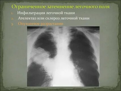 Разрешение инфильтрации в легких