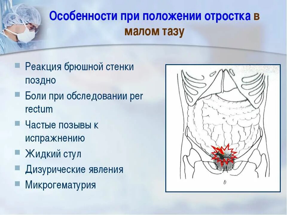 Асцит в малом тазу
