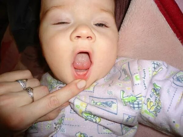 Стоматит в языкы у ребенка.