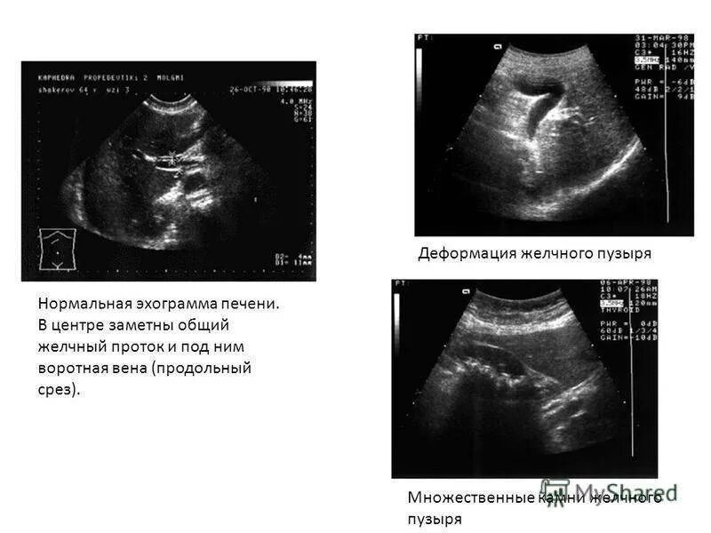 УЗИ признаки деформации желчного пузыря. Деформированный желчный пузырь УЗИ. S образный желчный пузырь УЗИ. Желчный пузырь деформирован перегибом УЗИ. Изгиб желчного симптомы