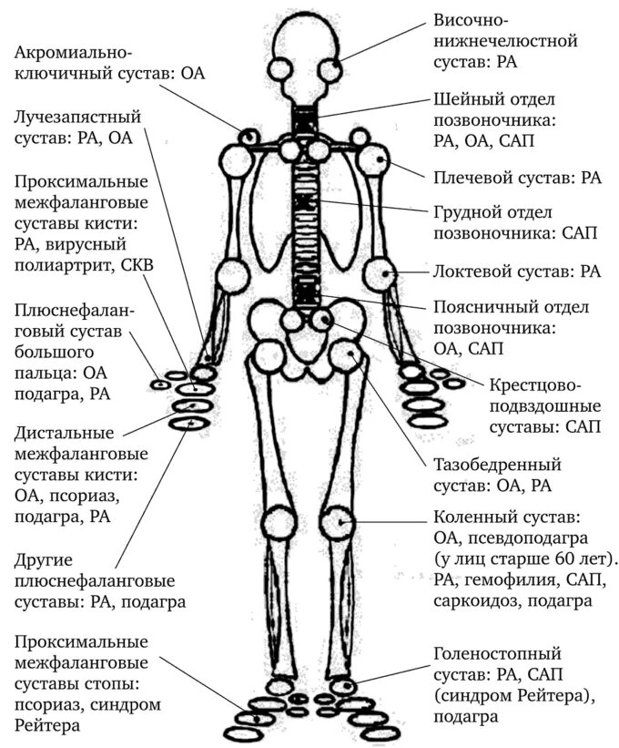 Остеоартроз типичная локализация. Типичная локализация артритов. Наиболее типичную локализацию и название остеоартроза.. Схема локализации суставов человека.