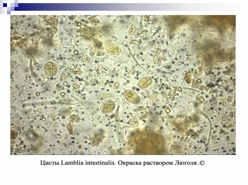 Цисты лямблий микроскопия. Копрограмма при хроническом гастродуодените. Копрограмма расшифровка йодофильная флора. Цисты лямблий микроскопия кала. Анализ кала результаты.