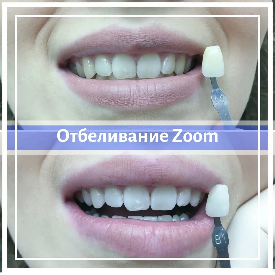 Стоит отбеливать зубы