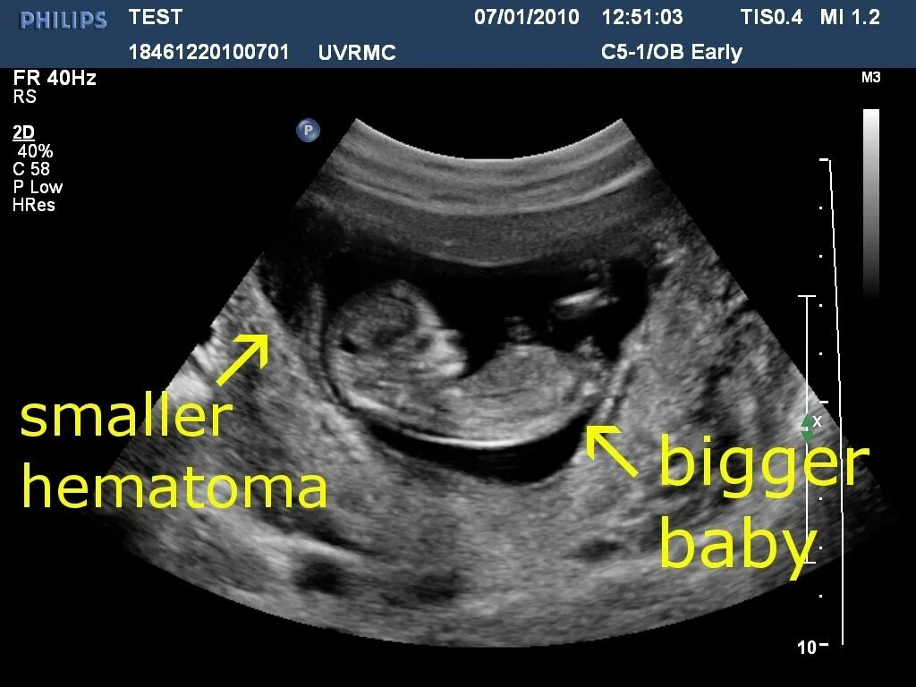 Гематом 7 недель. Ретрохориальная гематома на 12 неделе беременности. Гематома в матке при беременности 12 недель.