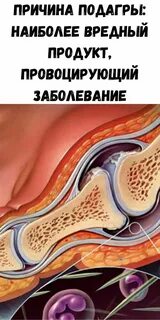 Лечение подагры на ноге отзывы