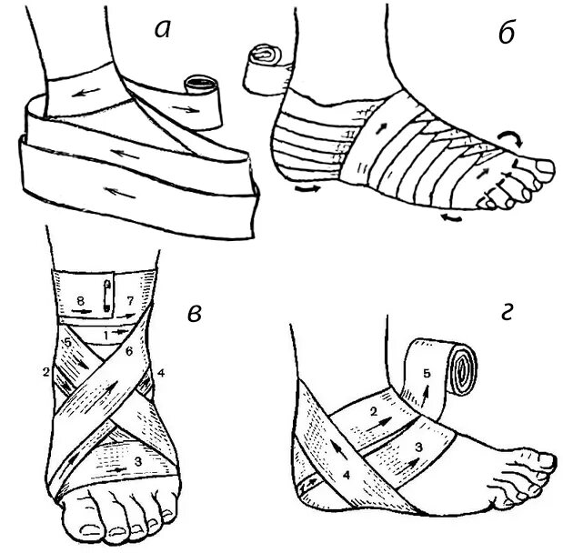 Как правильно забинтовать эластичным бинтом
