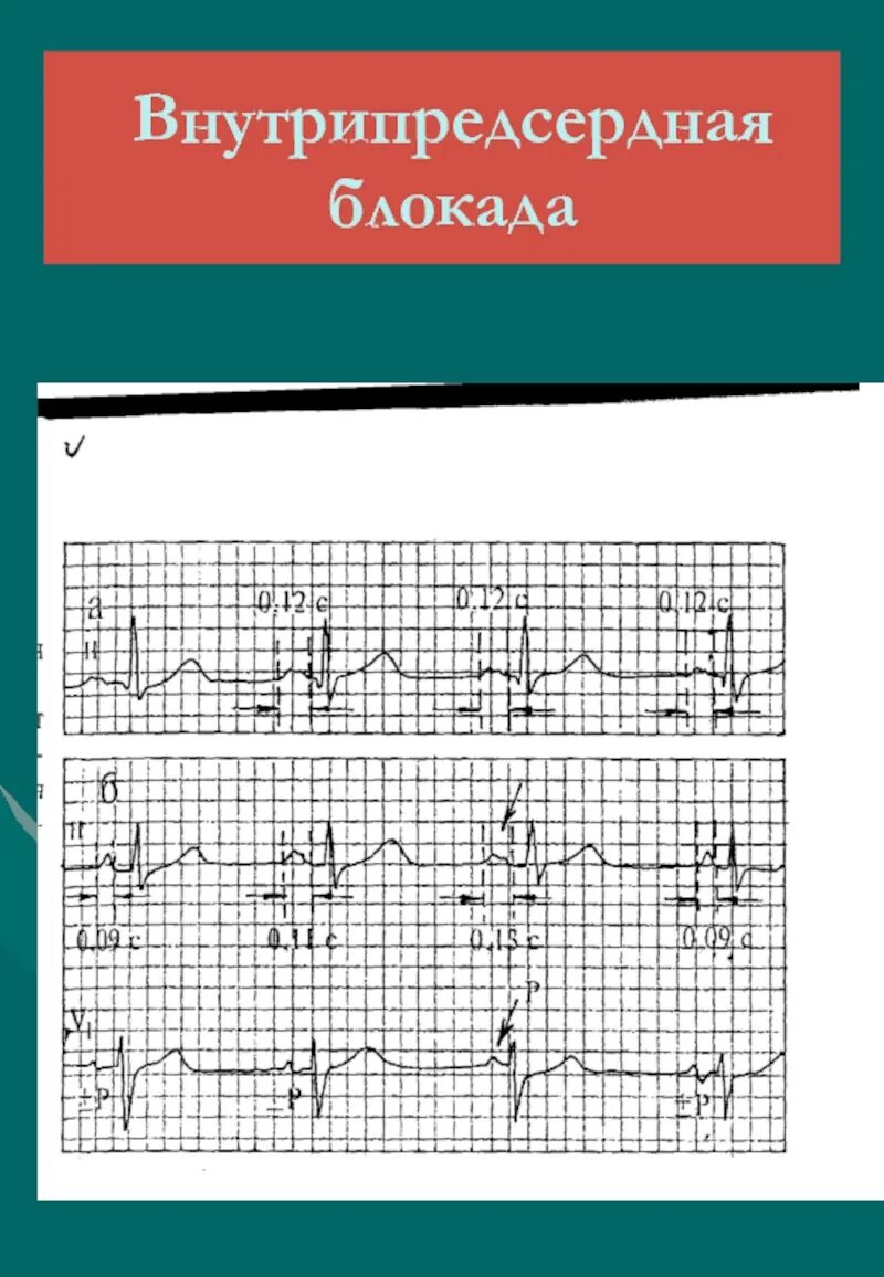 Что значит внутрипредсердная внутрипредсердная блокада. Внутрипредсердная блокада на ЭКГ. ЭКГ при внутрипредсердной блокаде. Внутрипредсердные блокады на ЭКГ. Внутрипредсердная блокада 1 степени.