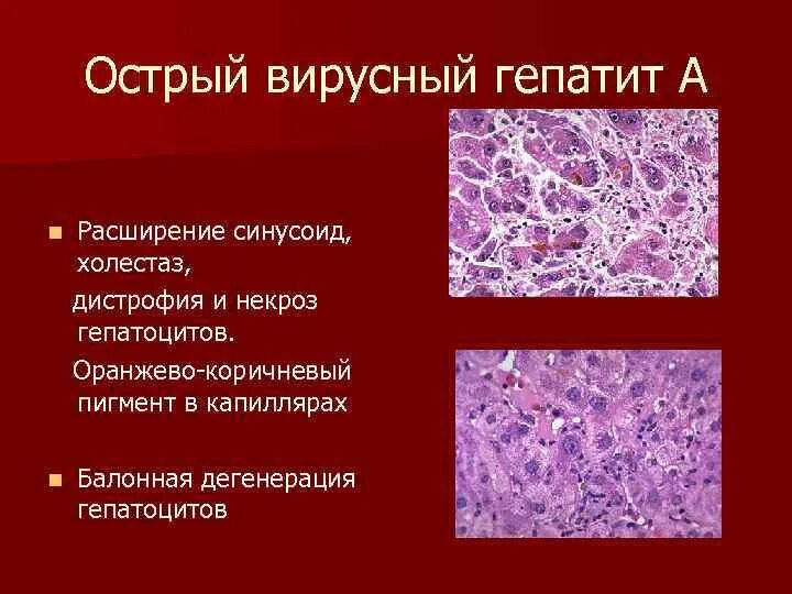 Острый массивный некроз печени гистология. Гепатоциты печени гистология. Дистрофия и некроз гепатоцитов.