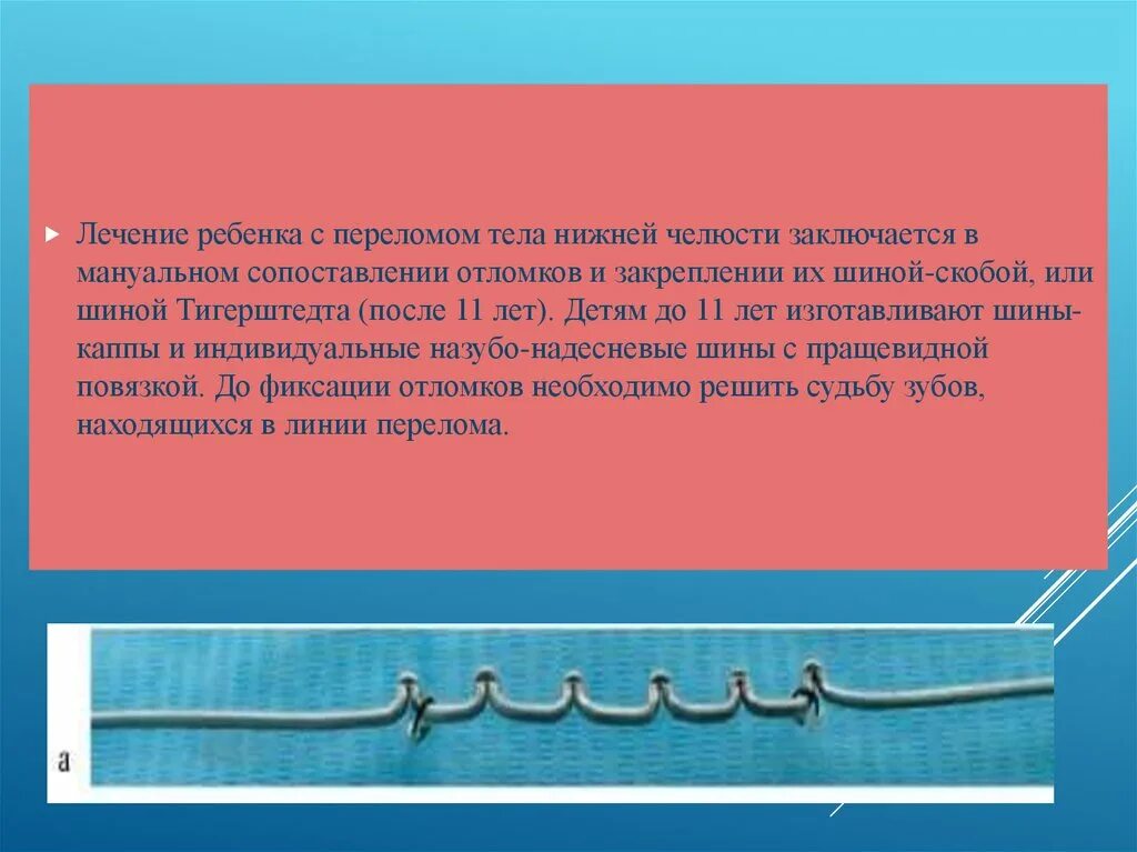 Лечение трещин у ребенка. Сопоставление костных отломков. Зуб находящейся в линии переломат. Перелом нижней челюсти шина Тигерштедта.