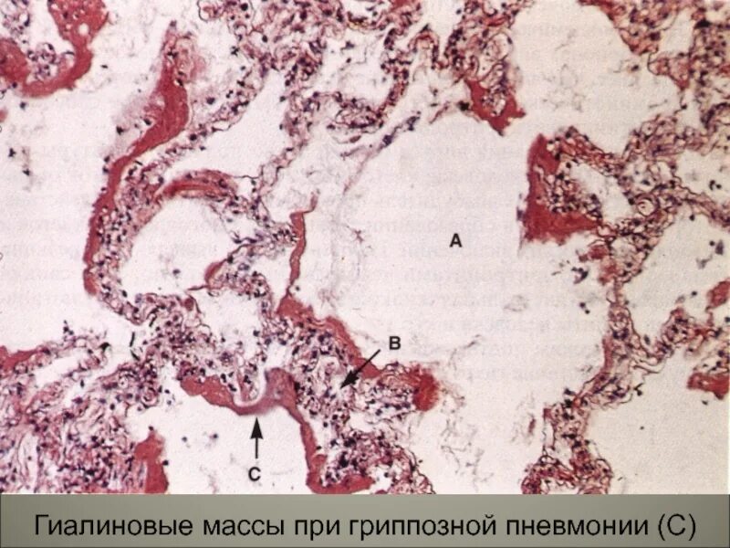 Гриппозная пневмония патанатомия. Крупозная пневмония патанатомия. Гриппозная пневмония макро. Гриппозная пневмония патологическая анатомия.