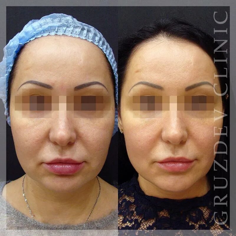 нити полимолочной кислоты для лица