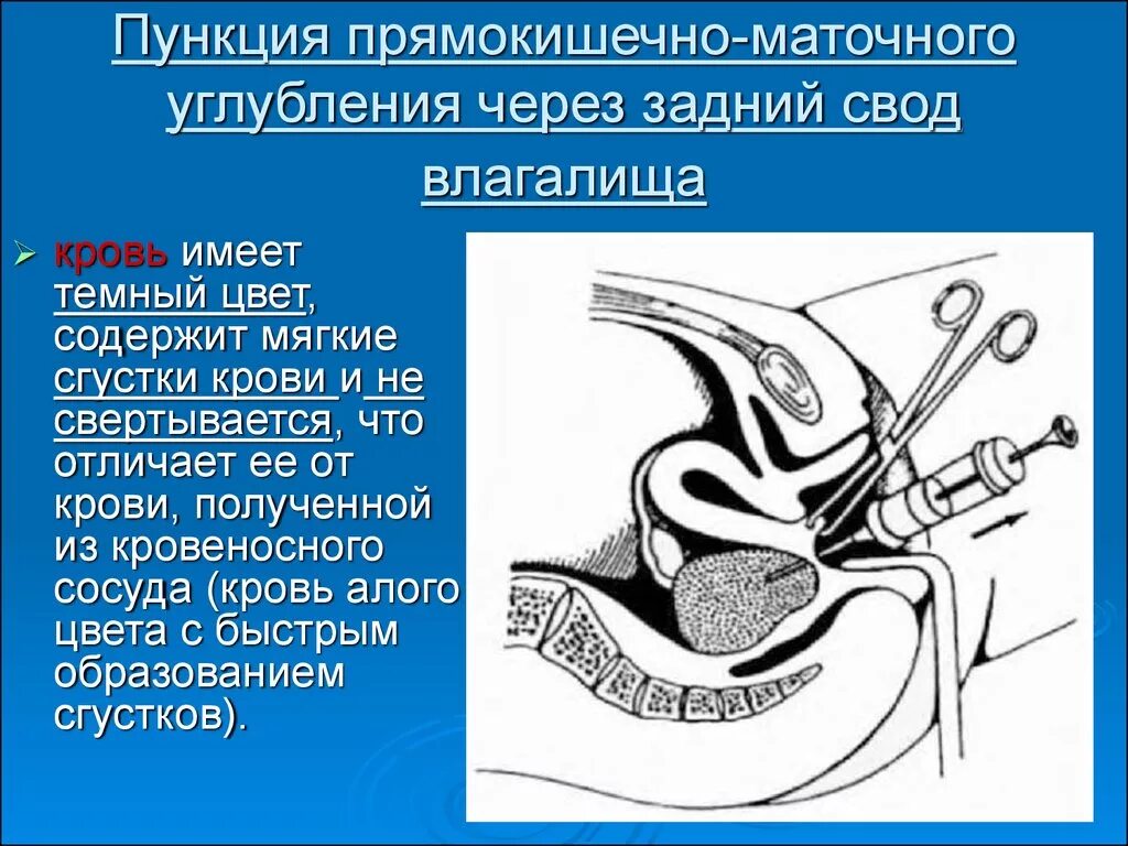 Глубокие своды. Пункция заднего свода брюшной полости. Пункция заднего свода в гинекологии. Прямокишечно-маточное пространство. Пункция прямокишечно-маточного углубления.