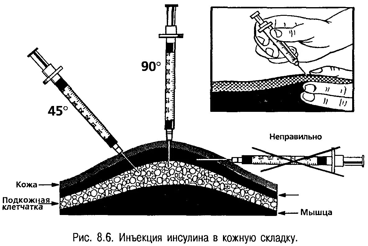 Вводи плавнее. Алгоритм инъекции инсулина подкожно. Введение инсулина подкожно инсулиновым шприцом алгоритм. Укол подкожно инсулиновым шприцом. Схема инсулинового шприца.