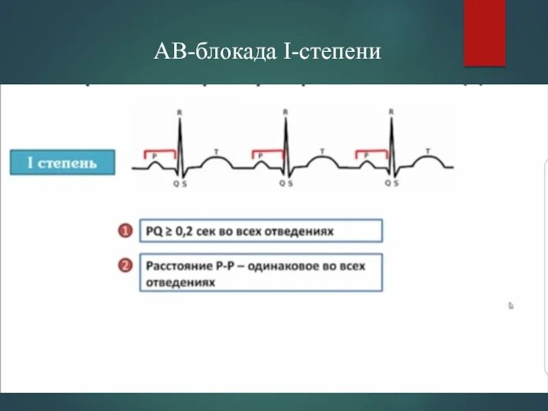 АВ блокада 1 степени на ЭКГ. Блокада первой степени на ЭКГ. Неполная АВ блокада 1 степени. Неполная АВ блокада 1 степени на ЭКГ.