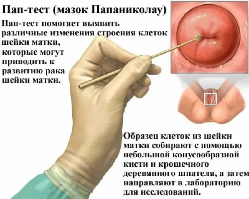 Можно Ли Заниматься Сексом Перед Цитологией