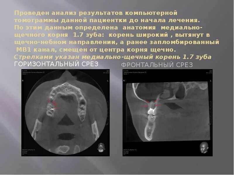 Узнать результаты кт. Медиально щечный канал зуба. результаты кт.