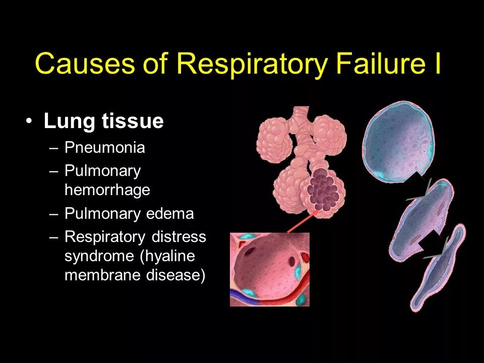 Презентация на тему пневмония у детей. Pneumonia respiratory rate. Эмфизема легких классификация. Пневмония легочных альвеол. Pneumonia respiratory rate.