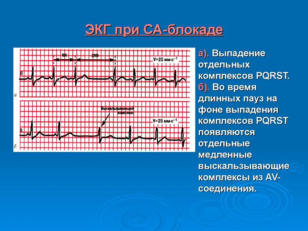 Комплекс блокада. Выпадение комплекса QRS на ЭКГ. Синоатриальные блокады на ЭКГ. Комплексы из АВ соединения. Медленные замещающие выскальзывающие комплексы и ритмы.