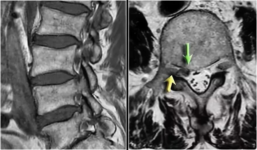 Медианно парамедианная билатеральная. Грыжа диска l4-l5 на мрт. Грыжа диска l5-s1. Протрузии l4 l5. Медианная грыжа l2-l3.