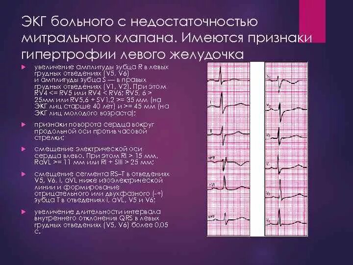 Амплитуда зубца r. Амплитуда зубца r
