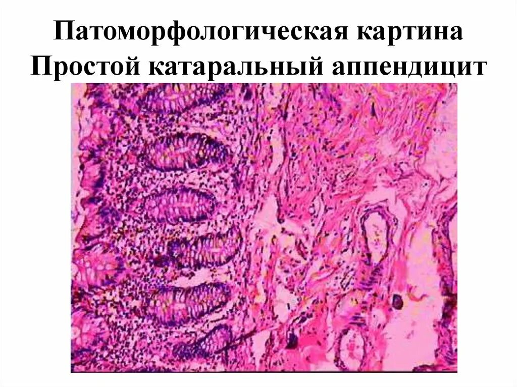 Флегмонозный аппендицит патанатомия. Флегмонозный аппендицит препарат патанатомия. Флегмонозно-язвенный аппендицит гистология. Катаральный аппендицит патанатомия препарат.