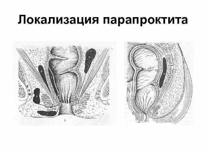 Транссфинктерный свищ прямой кишки