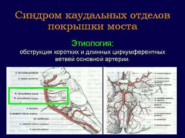 Синдром основной артерии. Ветви основной артерии. каудальный отдел. каудальный отдел ствола.