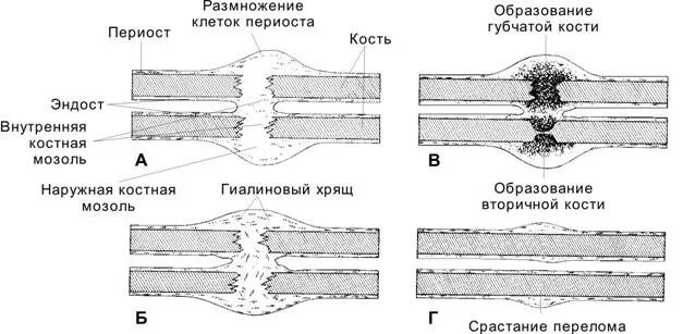 Схема образования костной мозоли. Первичная и вторичная костная мозоль. Этапы образования костной мозоли. Фазы формирования костной мозоли.