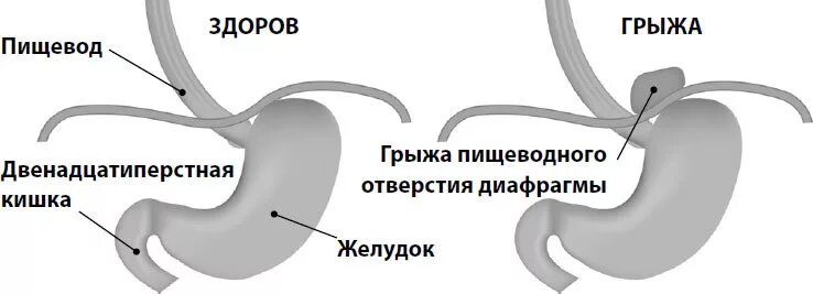 Пролапс желудка в пищевод. Параэзофагеальная грыжа диафрагмы. Скользящая грыжа пищеводного отверстия диафрагмы 2 степени. Грыжи пищеводного отверстия диафрагмы (ГПОД). Грыжа отверстия пищевода.