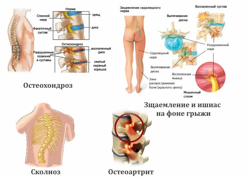 Боли в пояснице название