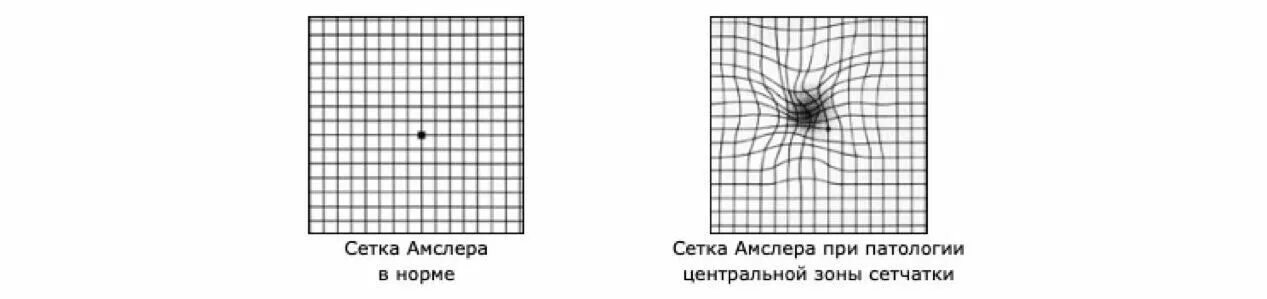 Тест на сетчатку. Тест сетчатки амслера. решетка амслера в офтальмологии. сетка для проверки зрения амслера. скотометрия тест амслера-маринчева.