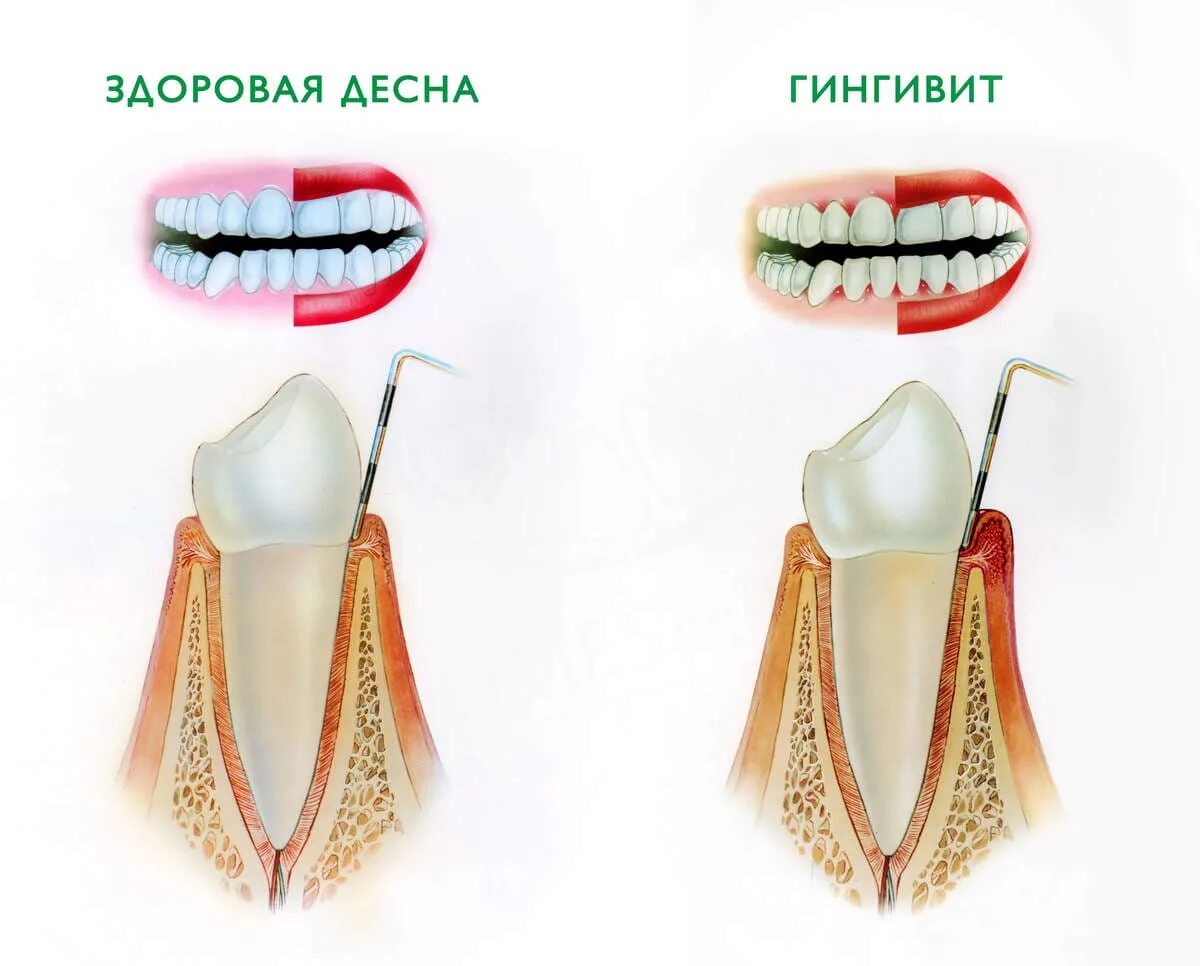 Меркуриальный гингивит. Гипертрофированный гингивит.