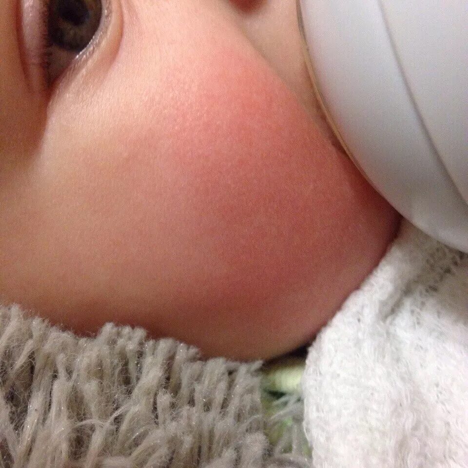 Красная щека у грудного ребенка. Красные щеки у новорожденного. Красные щеки у грудничка. Красная щека у грудного ребенка. Экссудативный катаральный диатез.