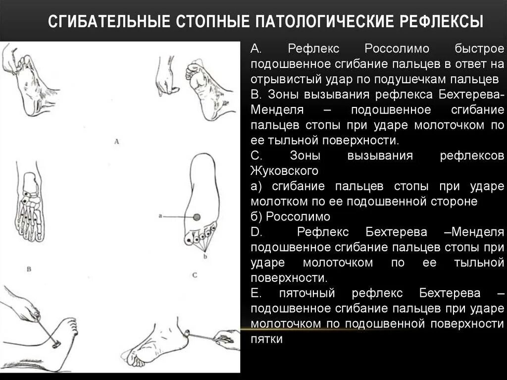 Рефлексы Бабинского, Оппенгейма, Россолимо. Патологические рефлексы симптом Бабинского. Патологические сгибательные рефлексы Россолимо. Рефлексы Бабинского Оппенгейма Гордона Шеффера Россолимо Жуковского.