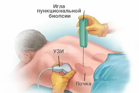 Пункция печени как делают
