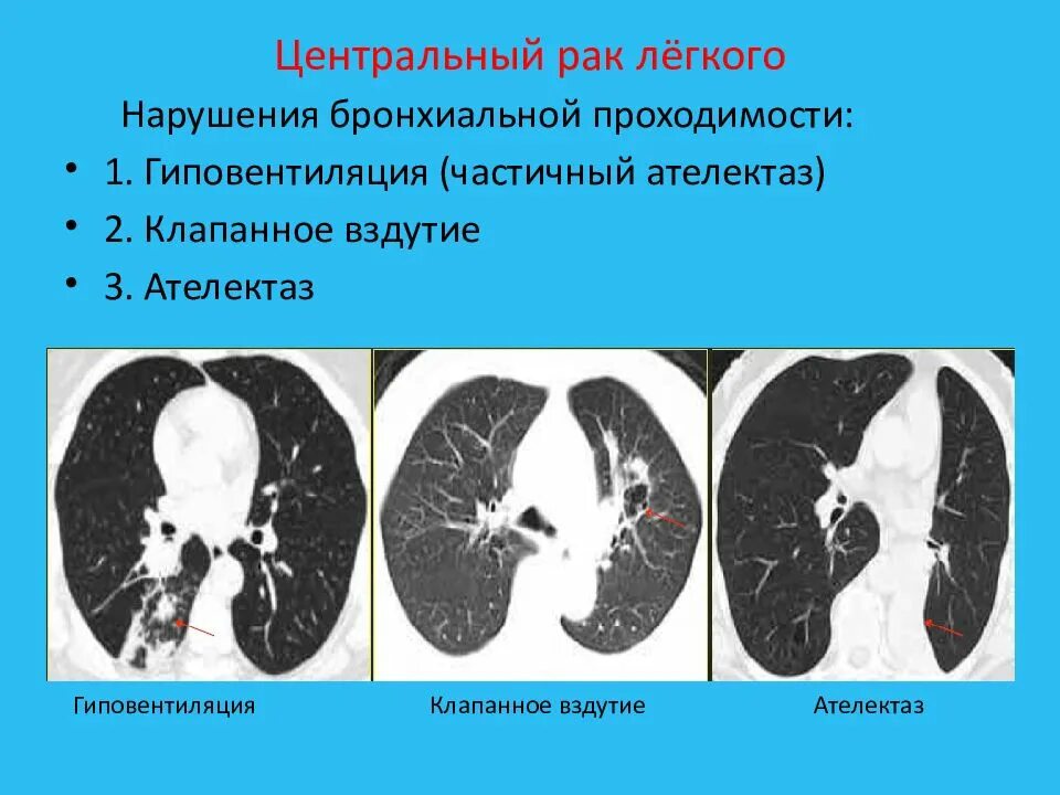 Центральный рак правого. Зона гиповентиляции в легких на кт. Уентральныйрак легкого. Центральная опухоль легкого.