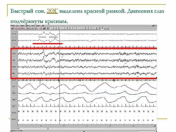 Плохое ээг. Полифазные потенциалы на ээг у детей. альфа ритм ээг. ээг-корреляты фаз сна.. ээг мониторинг ночного сна у детей.